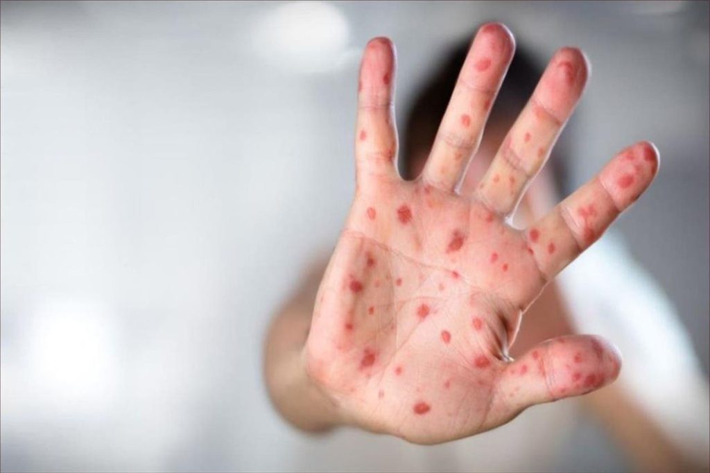 إجراءات جديدة لمكافحة مرض بوحمرون في المدارس